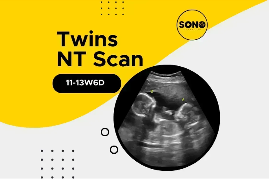 Twins NT Scan