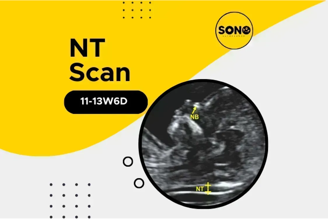 Nuchal Translucency Scan Malaysia